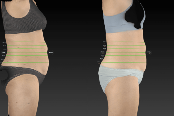 Image of same woman from the side highlighting her midsection to show the fat reduction from red light therapy.