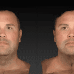 Image of a man's face to show the reduction of face fat from red light therapy.