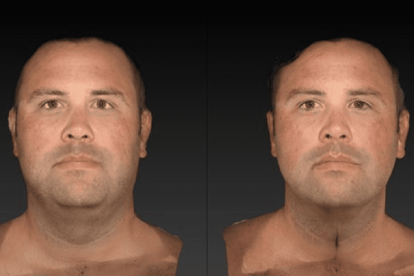 Image of a man's face to show the reduction of face fat from red light therapy.