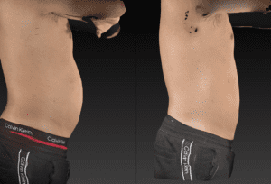 2 images of the same man with no shirt on and black shorts. The image is of his bare midsection showing progression of belly fat loss from red light therapy.