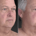 2 Images of older man's face side by side to show the reduction of fat in the face and neck from red light therapy.