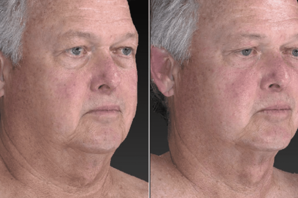 2 Images of older man's face side by side to show the reduction of fat in the face and neck from red light therapy.