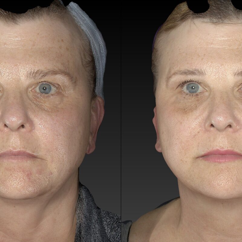 Fat Loss Red Light Therapy Weight Loss Before and After Contours